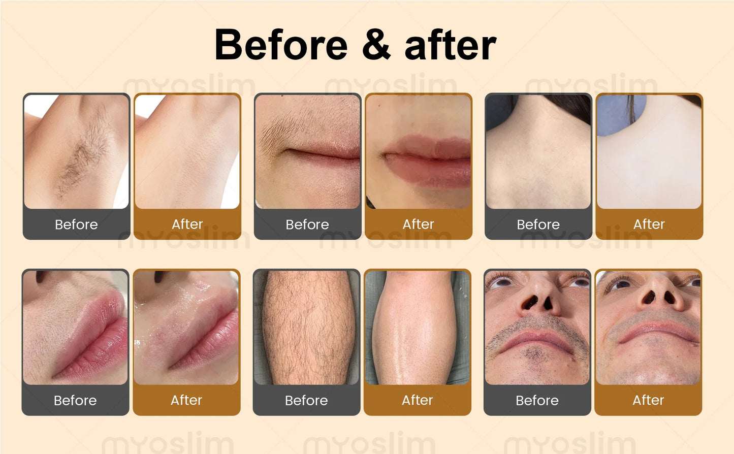 MYOSLIM Soprano Diode Hair Removal Laser 755 808 940 1064