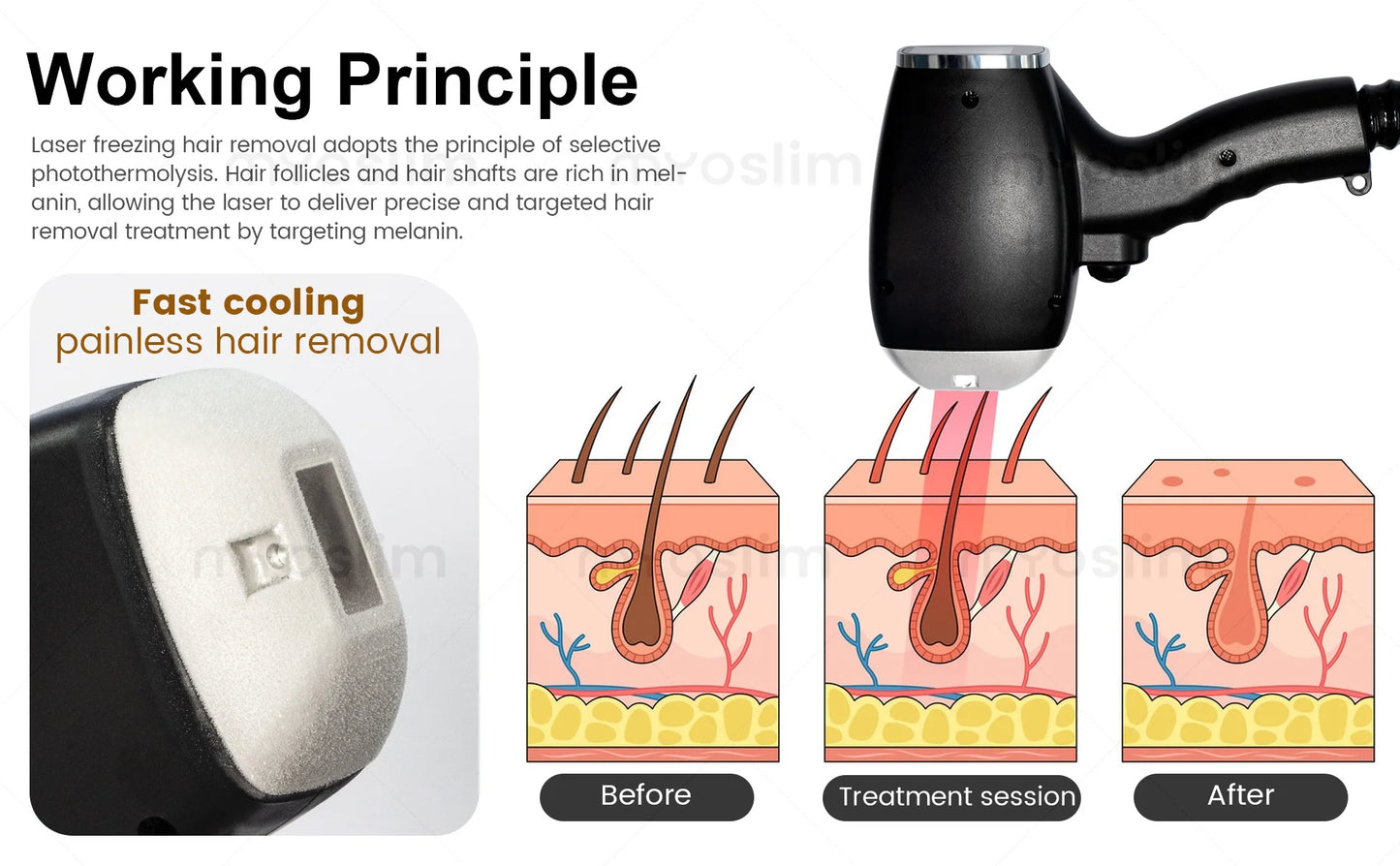 MYOSLIM Soprano Diode Hair Removal Laser 755 808 940 1064
